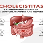 Cholecistitas: A Comprehensive Guide to Causes, Symptoms, Treatment, and Prevention